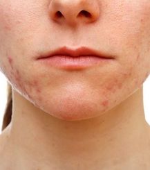 acne esthetique